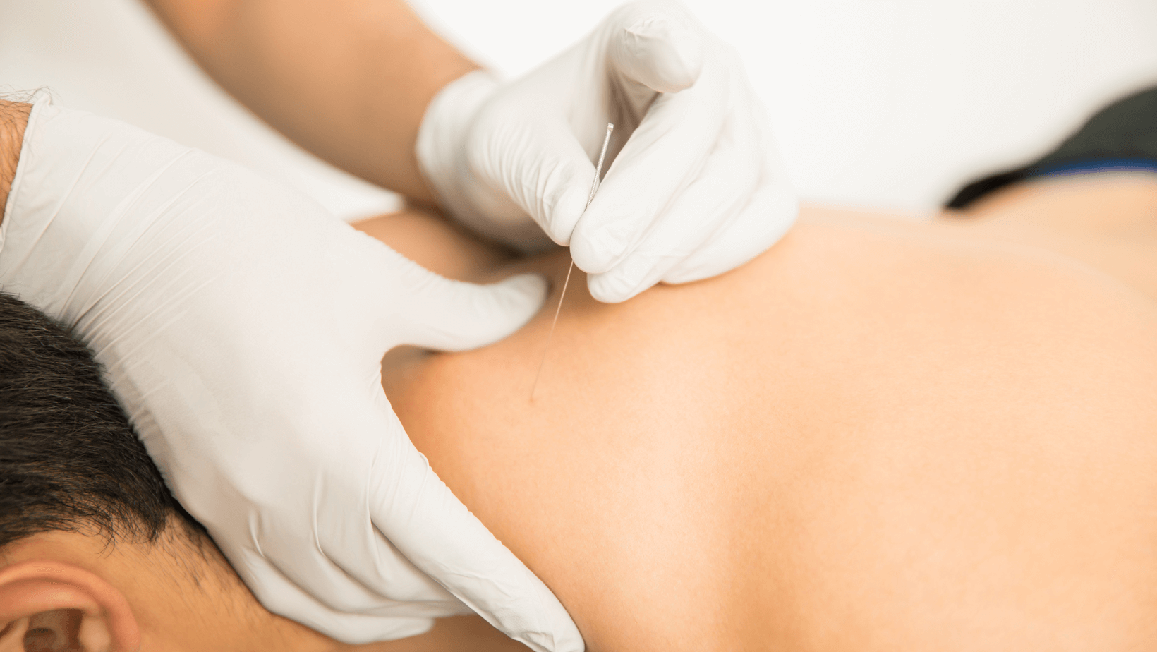 Image of someone receiving a dry needling treatment